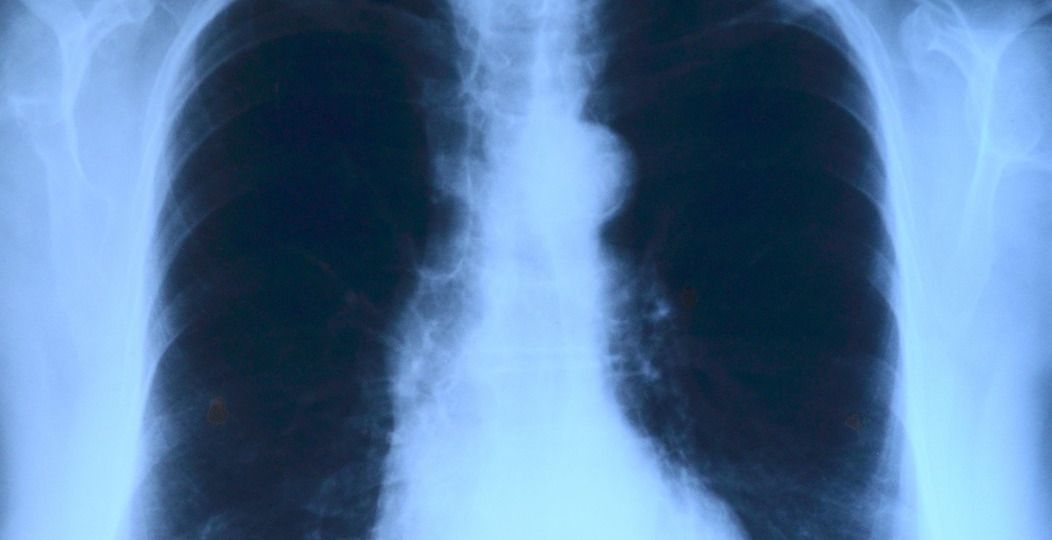 lung-x-ray.jpg