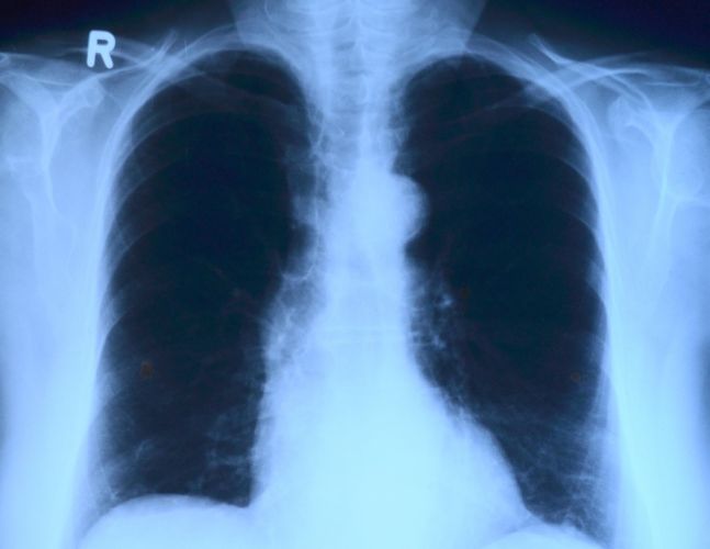 lung-x-ray.jpg