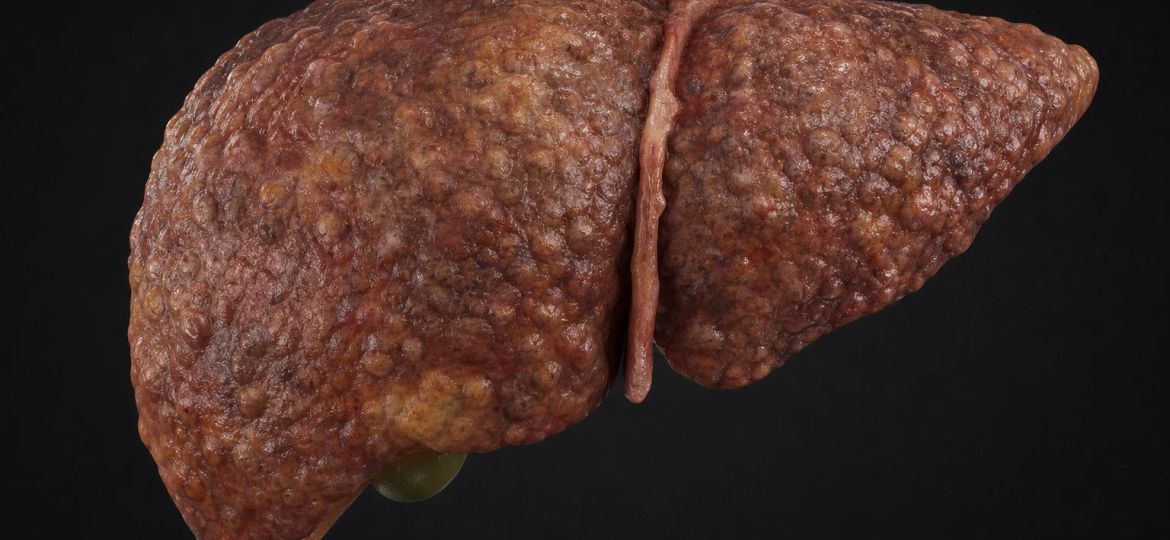 Illustration of a human liver with a scarred, nodular surface