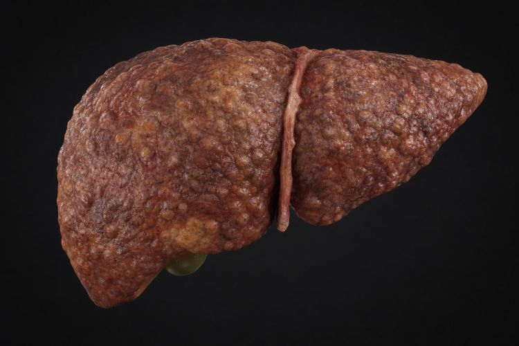 Illustration of a human liver with a scarred, nodular surface