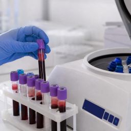 Blood sample tubes being placed in a rack in a lab